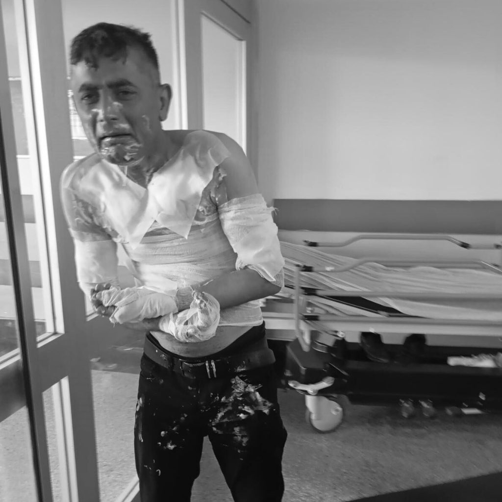 İstanbul'da Engelli Vatandaşa Şok Saldırı: Telefonunu Çalan Şahıs Tarafından Benzinle Yakıldı